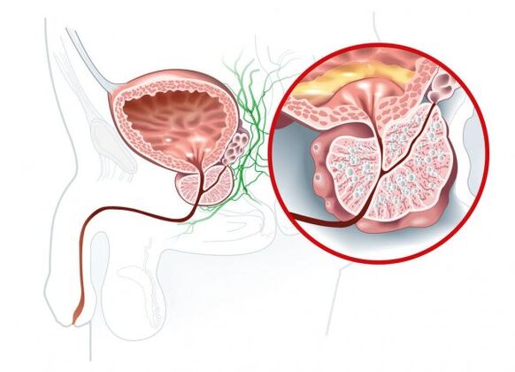 Prostatit belirtileri