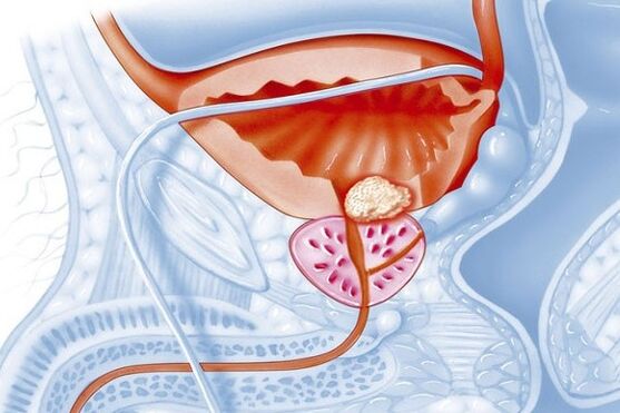 Prostatta inflamatuar süreç