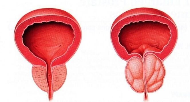 kronik prostatit ile sağlıklı ve iltihaplı prostat