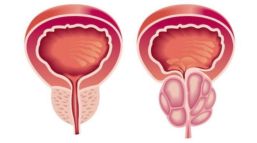 Prostatit ile sağlıklı ve iltihaplı prostat