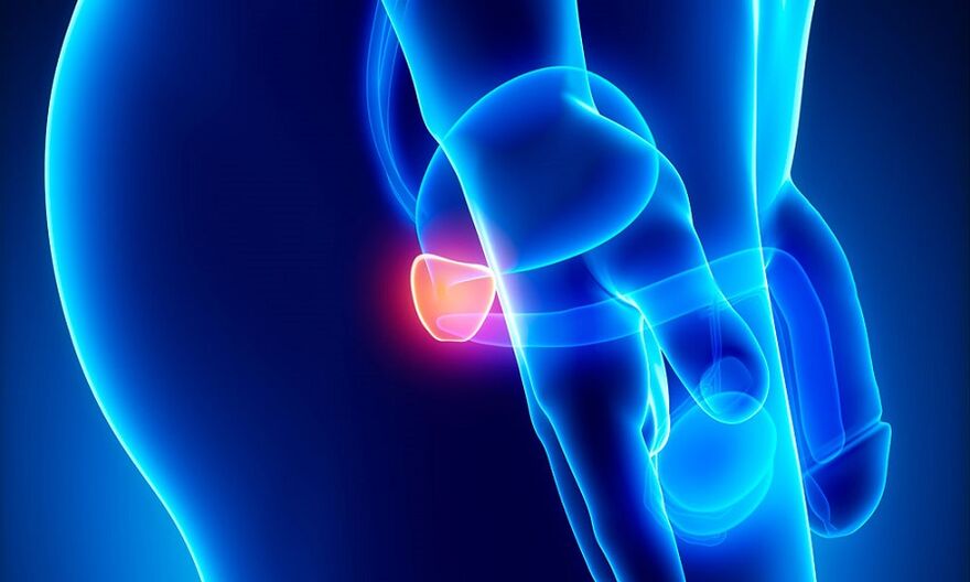 Prostatın prostatit ile iltihaplanması