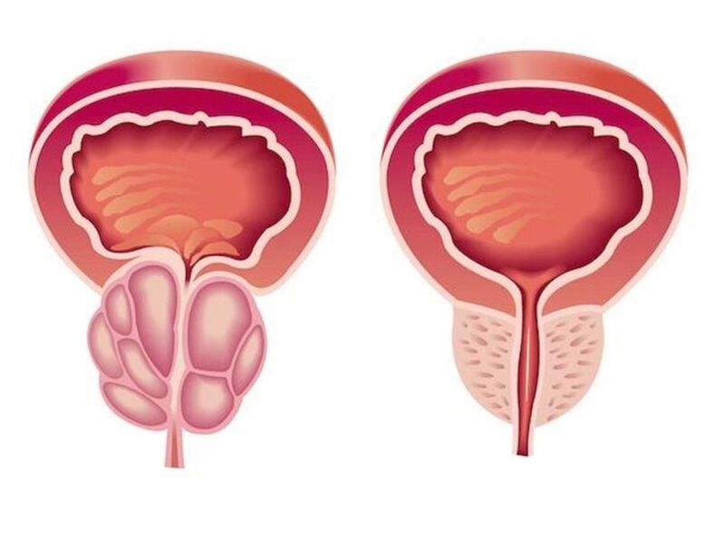 Prostatit nasıl görünüyor